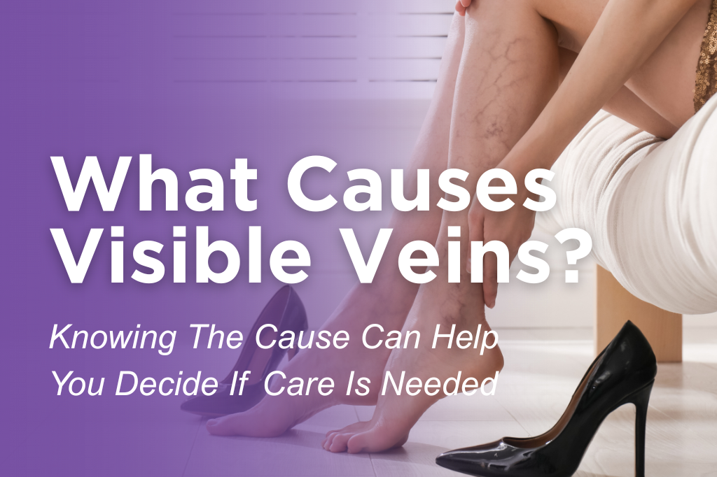 Woman touching her lower leg with visible spider veins, illustrating visible veins and when to consider vein care.