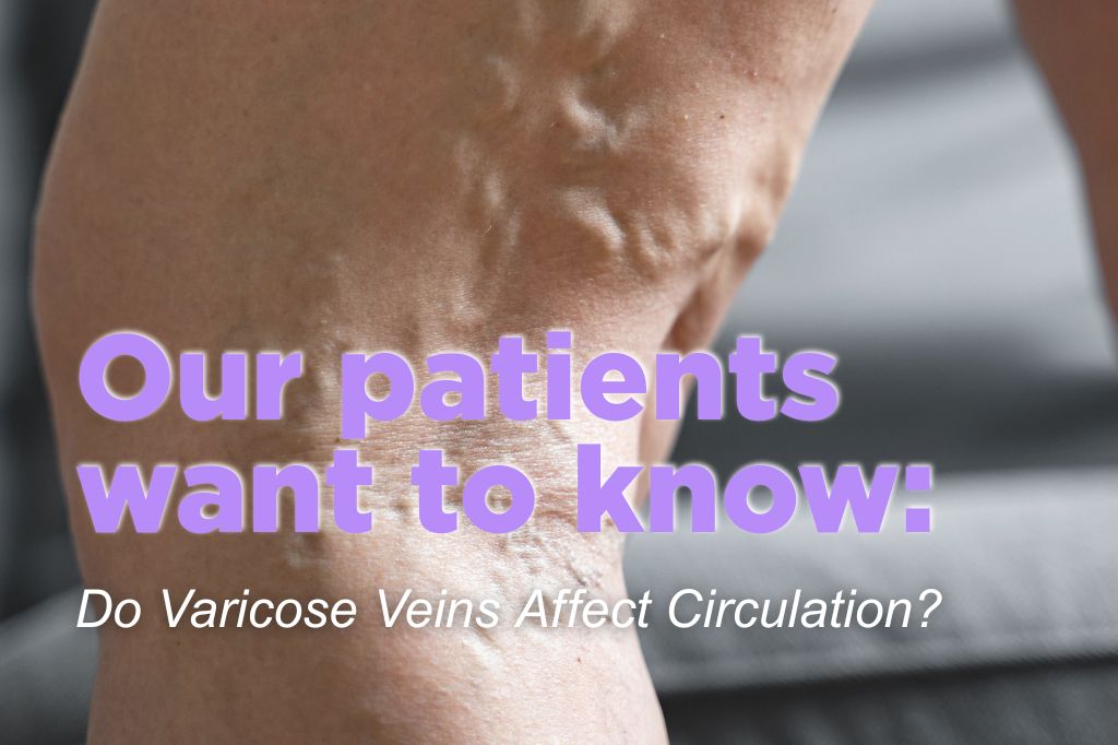 Varicose veins visible on lower leg in Hendersonville, TN, with caption Do varicose veins affect circulation?